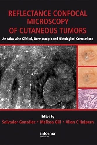 Reflectance Confocal Microscopy of Cutaneous Tumors: An Atlas with Clinical, Dermoscopic and Histological Correlations - Click to Buy