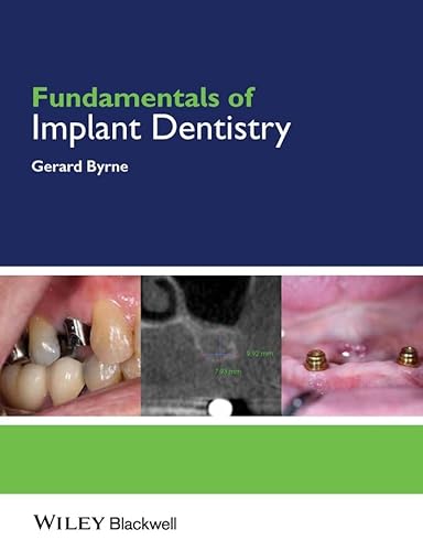 Fundamentals of Implant Dentistry - Click to Buy