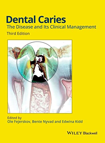 Dental Caries: The Disease and its Clinical Management - Click to Buy