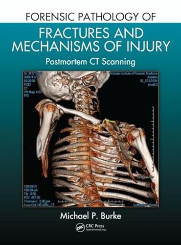 Forensic Pathology of Fractures and Mechanisms of Injury: Postmortem CT Scanning - Click to Buy