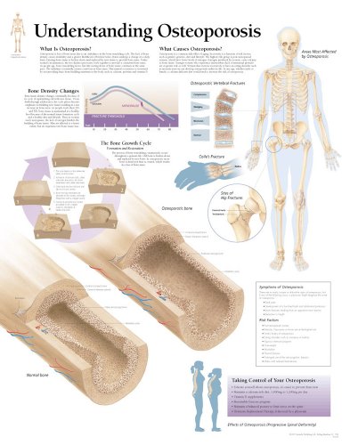 Understanding Osteoporosis chart: Laminated Wall Chart