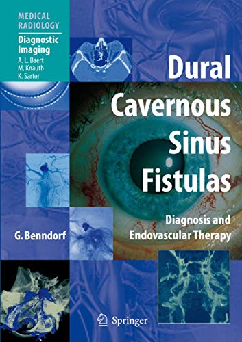 Dural Cavernous Sinus Fistulas: Diagnosis and Endovascular Therapy (Medical Radiology) - Click to Buy