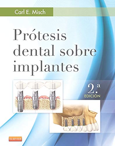Prótesis dental sobre implantes - Click to Buy