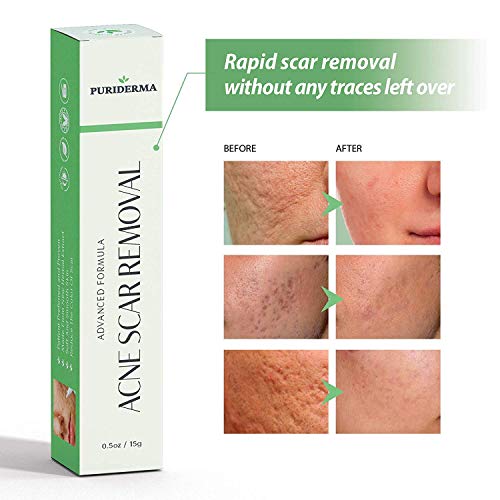 Acne Scar Removal Cream Treatment for Face, Remove & Lighten Old & New Scars, Spots & Marks, Natural, Gentle & Effective Herbal Extracts Formula - by PuriDerma (15 ml) - Click to Buy